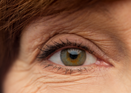 Dangers Of Eyelid Laxity