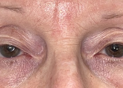 72 Years Old Upper Lid Blepharoplasty And Ptosis Before Surgery