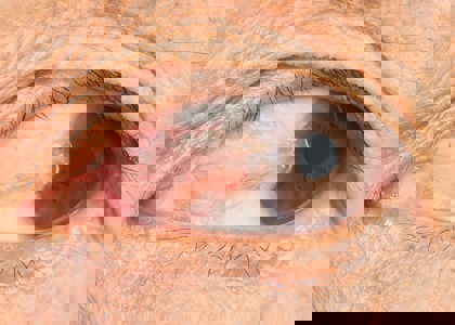 Pterygium Surgery
