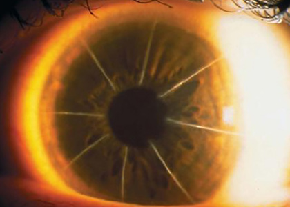 Improving Vision After Radial Keratotomy Pizza Pie Surgery