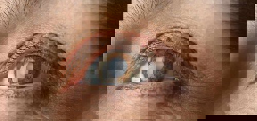 Living With Cataracts