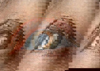 Living With Cataracts