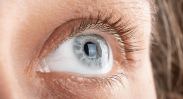 Laser Eye Surgery to Treat Corneal Scarring