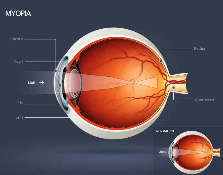 hyperopia myopia short sightedness