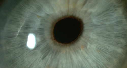 Eye lens closeup, implant surgery