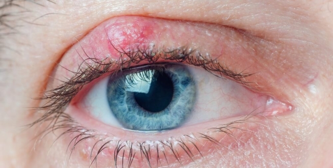 close up of an eye with chalazion